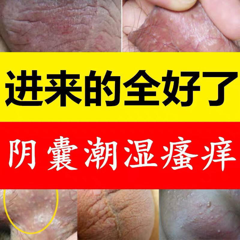 龜頭炎異味瘙癢淋性病脫皮私處紅斑污垢裂口珍珠疹梅毒包皮炎皰疹 露天市集 全台最大的網路購物市集