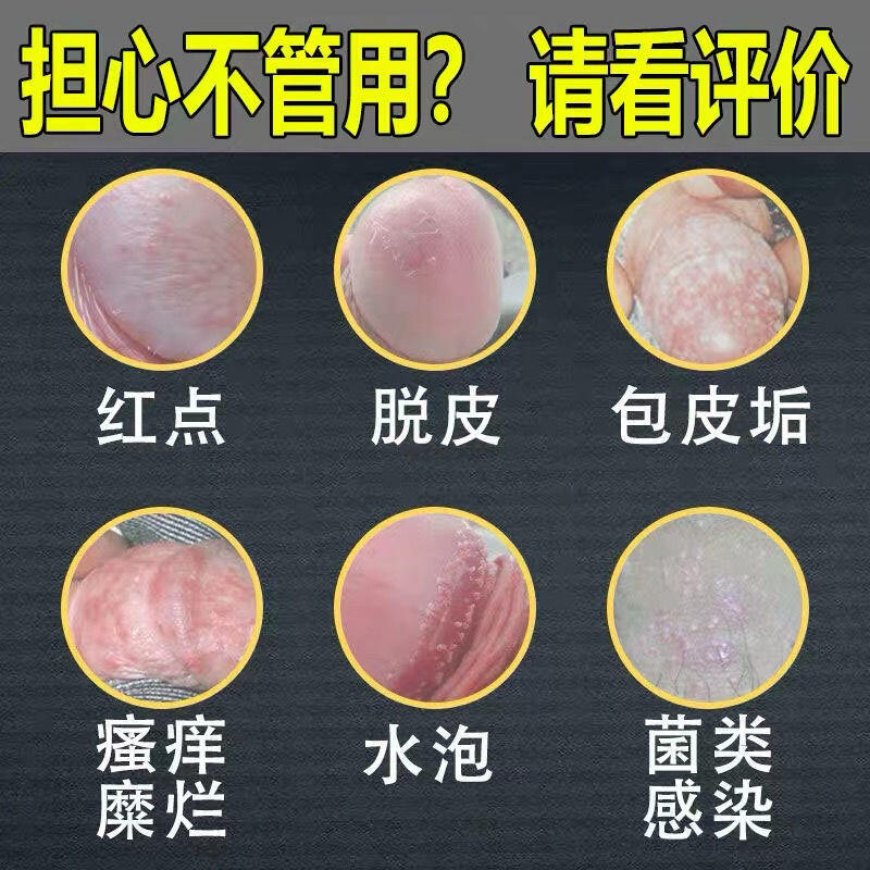 龜頭炎異味瘙癢淋性病脫皮私處紅斑污垢裂口珍珠疹梅毒包皮炎皰疹 露天市集 全台最大的網路購物市集